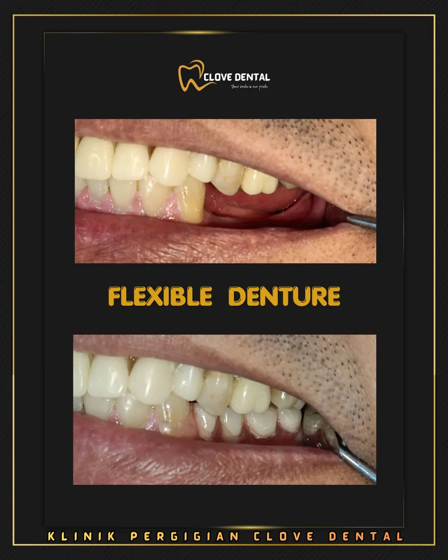 Before and after: flexible denture at Clove Dental