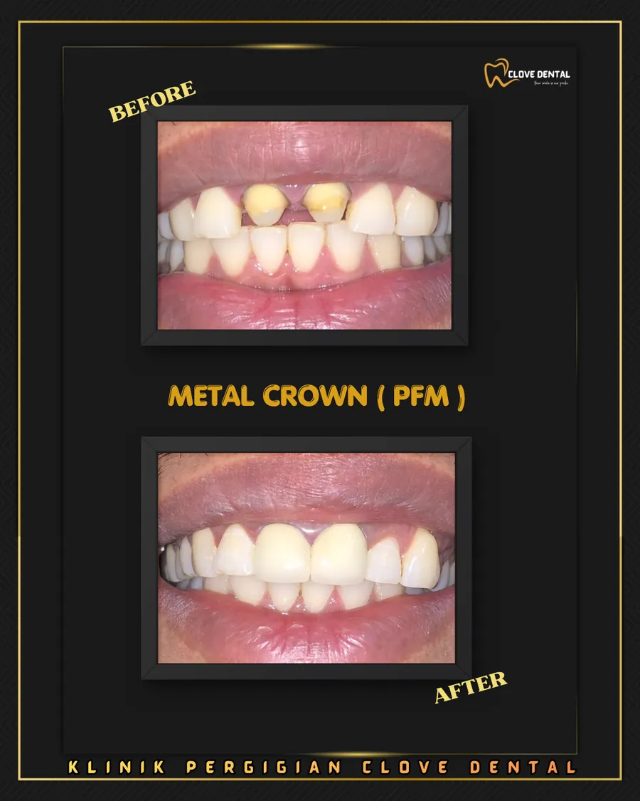 Before and after: metal-ceramic crowns at Clove Dental