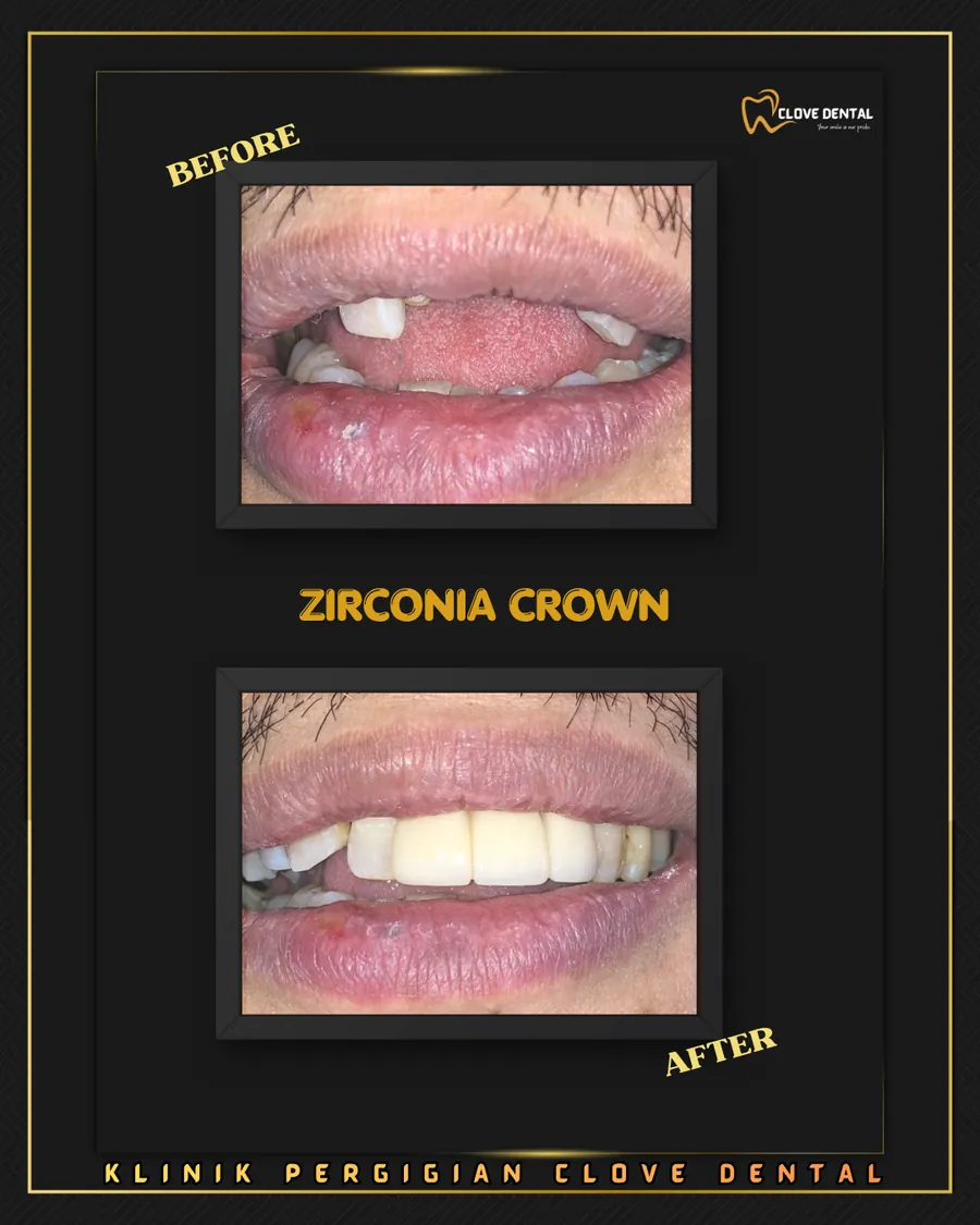 Before and after: zirconia crowns at Clove Dental